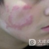 红斑狼疮患者的饮食注意事项