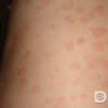 红斑狼疮的相关性预防有哪些