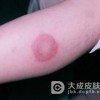 红斑狼疮病发因素有哪些