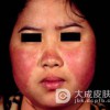 红斑狼疮是由什么原因引起的