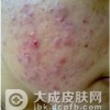 如何清除青春痘呢