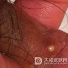 感染一期梅毒为何及早治疗