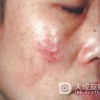 治疗生殖器疱疹有了四大突破