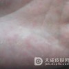 汗疱疹应该怎么正确地治疗才好呢