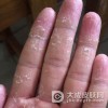 手发痒脱皮有可能是得了手癣吗