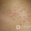 药物性皮炎患者所出现的皮肤症状