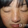 预防雀斑细节不容忽视