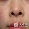 冬季如何预防雀斑