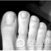 趾断症应该如何的治疗