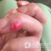 鸡眼的形成原因是什么呢