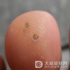 鸡眼治疗的注意事项有哪些呢