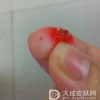 鸡眼在生活中会不会传染呢