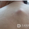 脂肪瘤的原因及治疗