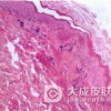 关于肠病性肢端皮炎的症状表现