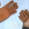肠病性肢端皮炎都会有什么治疗措施