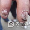 肠病性肢端皮炎的治疗都应注意什么