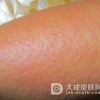 日光性皮炎的危害都有哪些呢