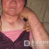 日光性皮炎的护理措施有哪