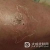 痈的知识大全