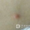 得了一期梅毒怎么护理好呢
