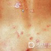 感染到一期梅毒还能治疗好吗