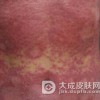 介绍一下副银屑病都到底有哪些类