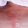 脖子出现皮肌炎的病症该怎么办