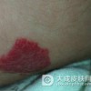 确诊蔓状血管瘤需要做哪些检查项目