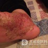 儿童脓包疮是怎么产生的