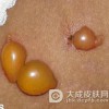 脓包疮的危害有哪些呢
