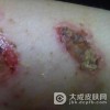 小儿脓包疮如何治疗呢