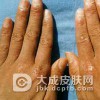 传染性湿疹样皮炎的主要的特点