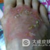 传染性湿疹样皮炎的临床表现都是什么呢