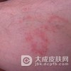 传染性湿疹样皮炎有哪些的皮损特点