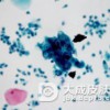 鳞状细胞癌都有哪些的并发症