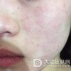 过敏性皮炎患者需补充哪些元素呢?
