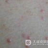 防治过敏性皮炎有哪些注意事项呢