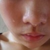 多汗症的发病的机理是什么