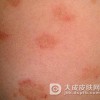 玫瑰糠疹最大的危害是什么呢