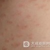 玫瑰糠疹的患者需要忌口吗