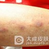 传染性红斑的病因是什么？