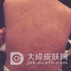 荨麻疹型药疹的一些症状
