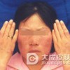 传染性红斑患者的饮食事项