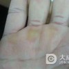 鸡眼和老茧的区别是什么