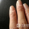 手癣的主要危害是什么呢