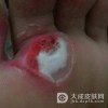 跖疣应该如何预防保健