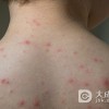 红斑狼疮为什么会复发