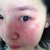为什么会得红斑狼疮