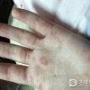 红斑狼疮的预防常识有哪些