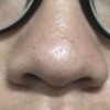 酒渣鼻患者日常注意事项